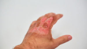 Why a Las Vegas Burn Accident Lawyer Is Important After a Serious Fire
